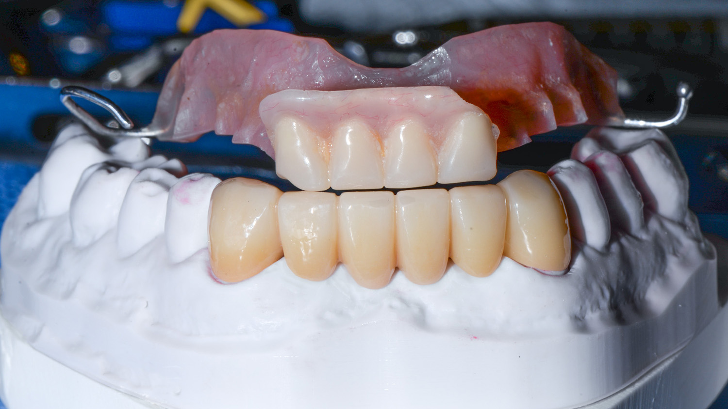 Your Guide to Understanding Flipper Teeth and Their Benefits